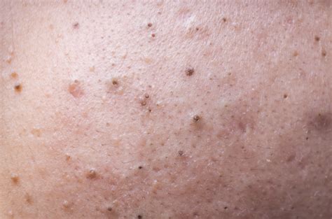 dr pimple blackheads|what causes blackheads.